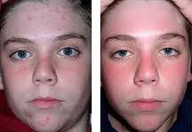 Acne Treatment - Vancouver Naturopaths Treat Acne Naturally