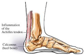 Plantar Fasciitis - Vancouver Radial Shockwave Therapy -Achilles ...